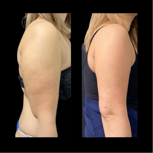 Nps Before-after-arm-liposuction-9-min